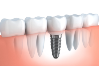 Dental Implants in Noida