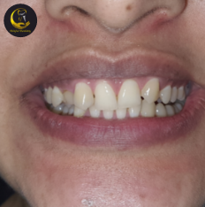 Invisible Braces in Noida Call Now ☏ 8368 008 170